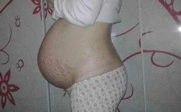 生男孩的妊娠线图片，看宝宝是男是女 生男孩的妊娠线图片