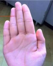 手指看相：小拇指短代表什么？ 手指尖麻木