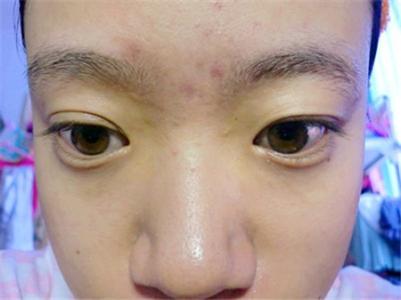 眉毛上长痘痘是什么原因？看健康 眉毛中间长痘痘是什么原因
