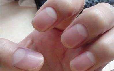 详解：指甲上的月牙人体健康有着怎样的联系 林赛氏指甲一定肾衰竭
