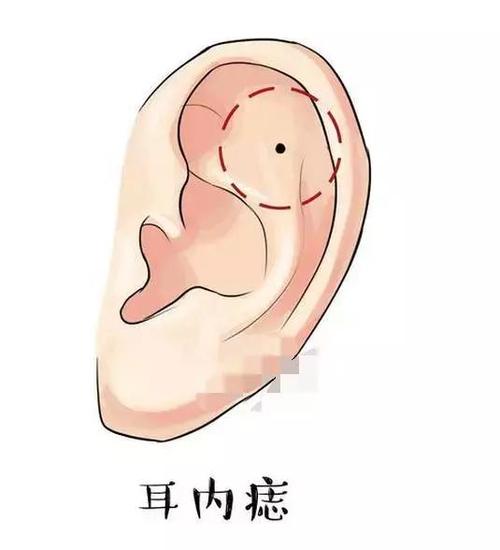 耳朵看命相有哪些说法 耳朵后面的痣命相图解