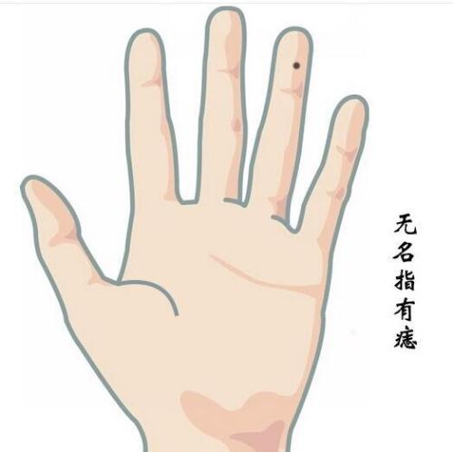 手上长痣 揭秘手上中指痣的含义 中指上有痣代表什么