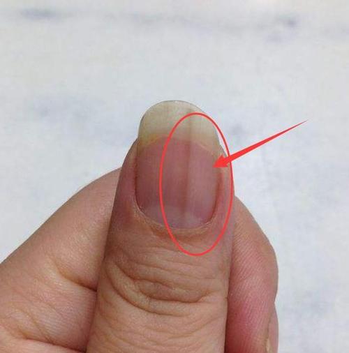 指甲上有竖纹是怎么回事 身体健康的晴雨表 指甲有竖纹