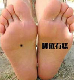 女人右脚脚底长痣的含义 右脚脚底有痣代表什么