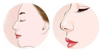 驼峰鼻面相怎么样 需不需要改善 驼峰鼻面相