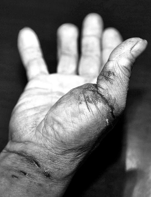 手掌内有伤痕好不好 手掌伤痕是否对手相有影响 手相