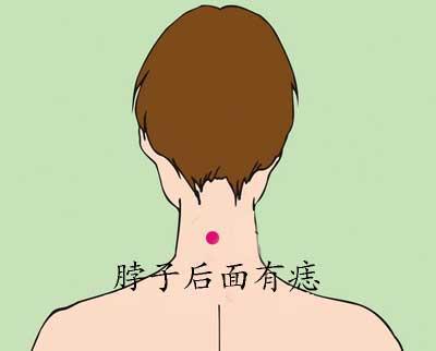 脖子后面有痣代表什么意思 后脖子有痣图解