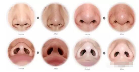 女人鼻翼比较大的在感情上如何 女人鼻翼大