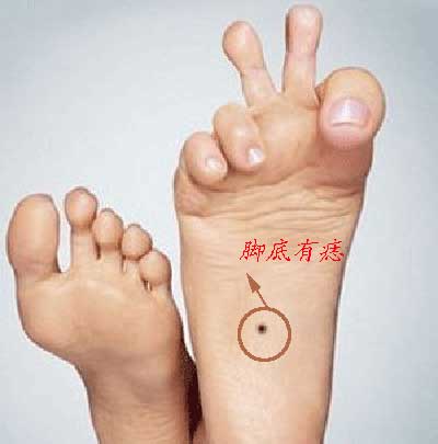 男人脚底有痣代表什么含义 好命吗？ 脚底有痣的人命怎么样