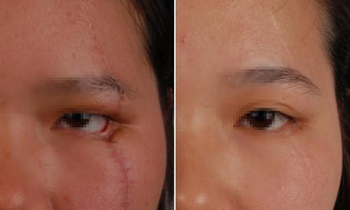 脸上的疤痕会影响自己的命运吗脸上有疤痕面相分析 面相疤痕