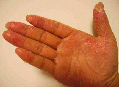 手掌脱皮是怎么回事 手掌脱皮缺什么维生素