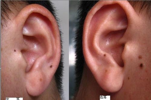靠近耳朵鬓角处有痣代表什么？ 靠近耳朵的头发里有痣