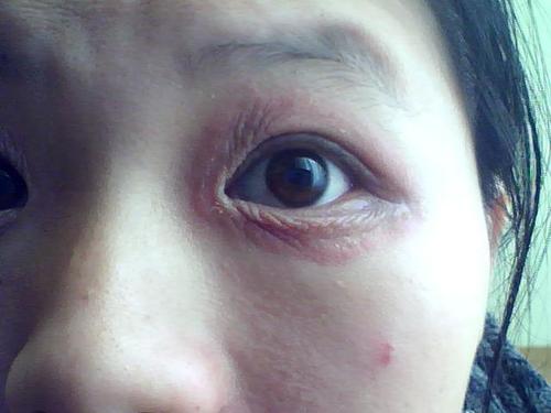 眼睑突出的女人怎么样 下眼睑肿是什么原因